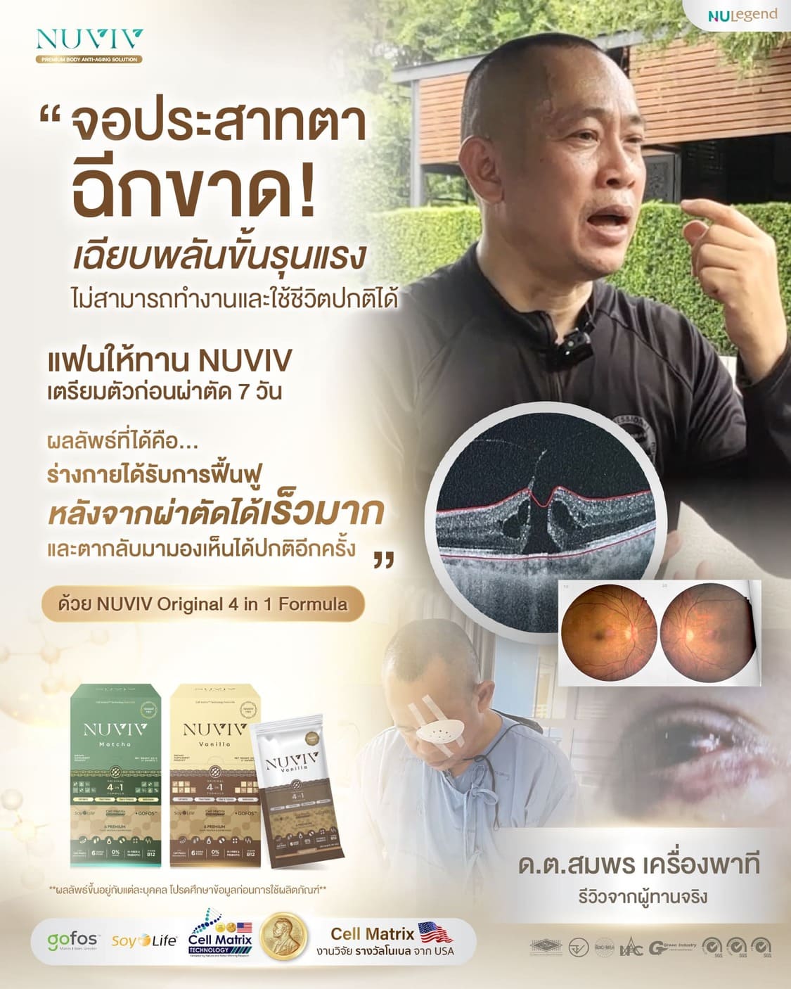 รีวิว NUVIV พี่ลุง จอประสาทตาเสื่อม.jpg