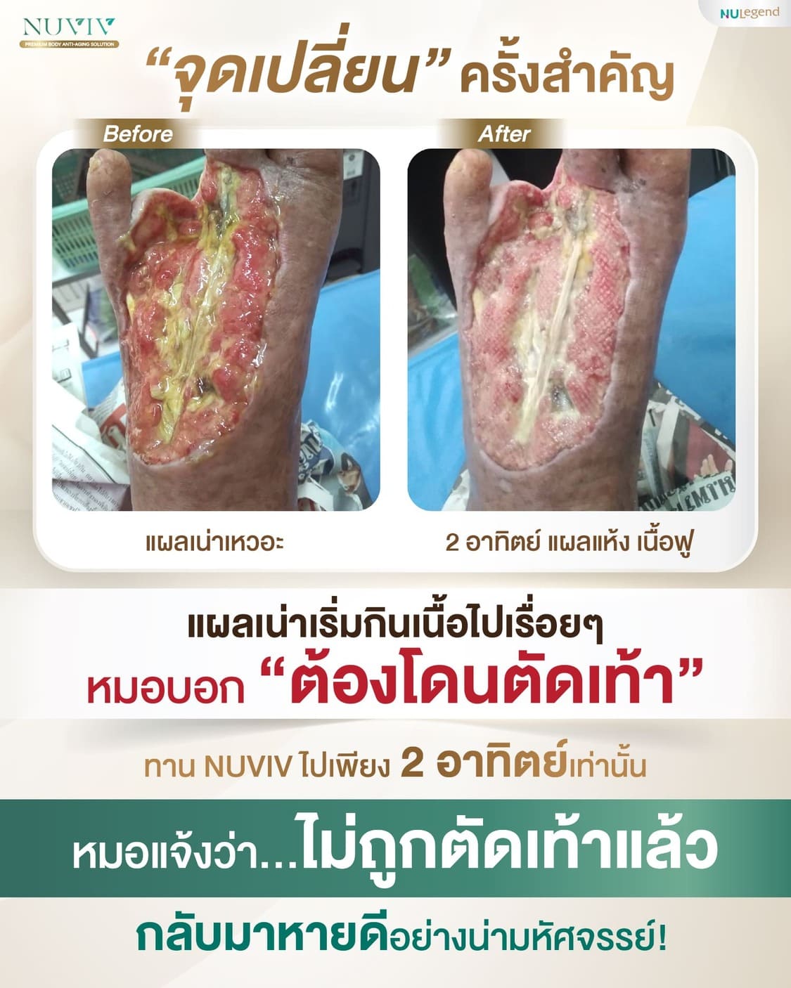รีวิว NUVIV เบาหวาน จุดเปลี่ยนครั้งสำคัญ แผลที่เท้า 2.jpg